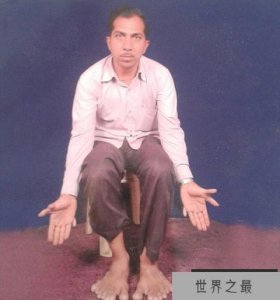 ​世界之最：印度男子有28根手指脚趾
